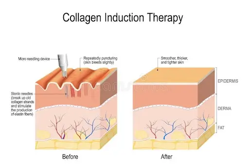 collagen-induction-theory